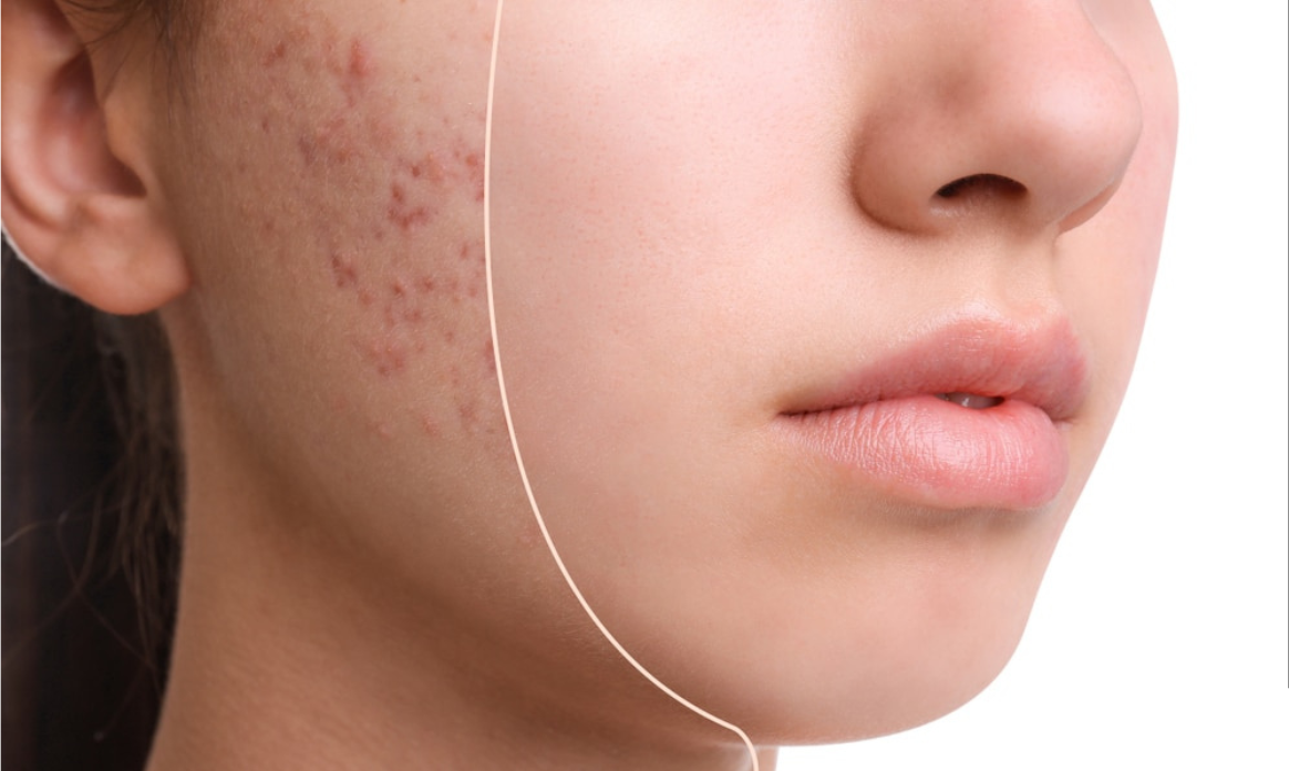 Acné
Le traitement au Laser AC Dual cible les bactéries responsables de l’acné et réduit l’inflammation de la peau.
    En savoir plus