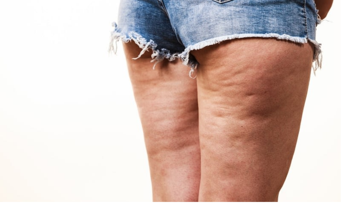 Cellulite
La cellulite provient d'une altération des tissus graisseux, créant un aspect inesthétique.
    En savoir plus