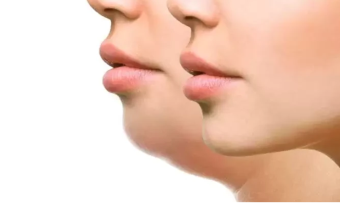 Double menton
Le double menton résulte d’une accumulation de graisse sous le menton, due à l’âge,  ou le poids.
En savoir plus