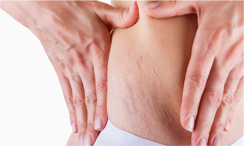 Vergeture
Le microneedling et le nano fractionnel réduisent les vergetures, raffermissent et réparent les dommages cutanés.
    En savoir plus