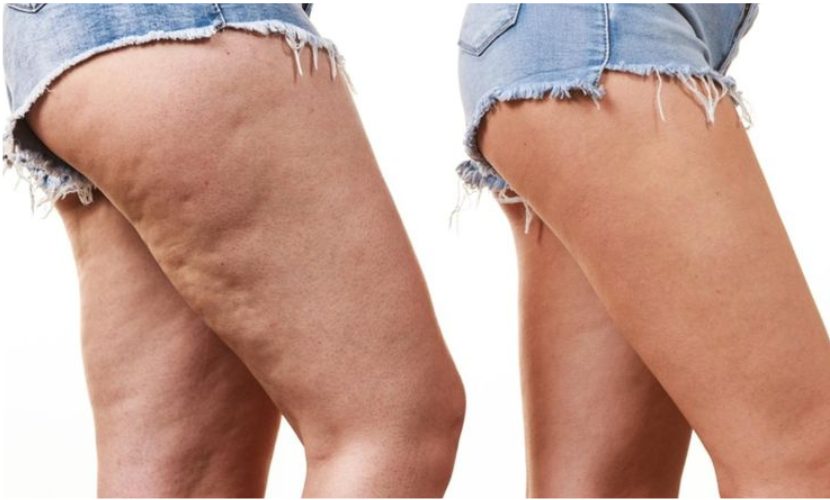 Cullote de chevale
La culotte de cheval désigne l'accumulation de graisse et de cellulite autour des hanches, des fesses et de la partie externe des cuisses.
    En savoir plus