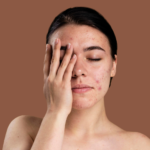 Acné et Cicatrices : Comprendre pour mieux traiter