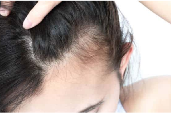 Perte de cheveux

Mésothérapie et microneedling stimulent la repousse, freinent la chute et densifient les cheveux naturellement.

    En savoir plus