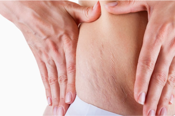 Vergeture

Le microneedling et le nano fractionnel réduisent les vergetures, raffermissent et réparent les dommages cutanés.

    En savoir plus