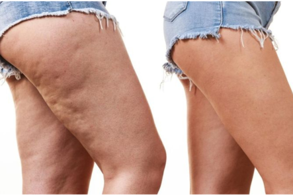 Cullote de chevale

La culotte de cheval désigne l'accumulation de graisse et de cellulite autour des hanches, des fesses et de la partie externe des cuisses.

    En savoir plus