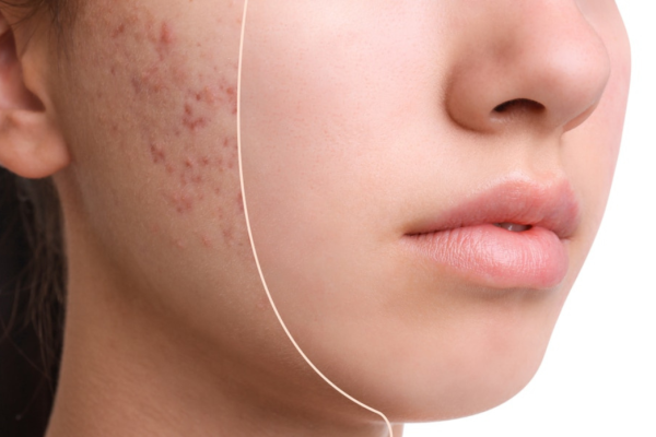 Acne
The AC Dual Laser treatment targets acne-causing bacteria and reduces skin inflammation.
Learn More