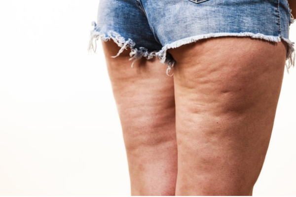 Cellulite
Cellulite is caused by changes in fatty tissue, creating an uneven and dimpled appearance.
Learn More