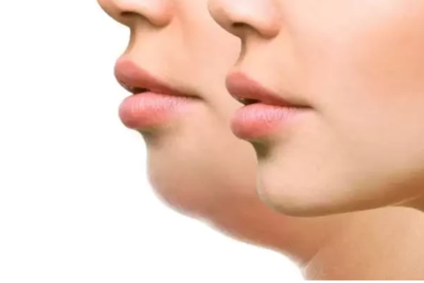 Double Chin
A double chin results from a buildup of fat under the chin, caused by aging, genetics, or weight.
Learn More